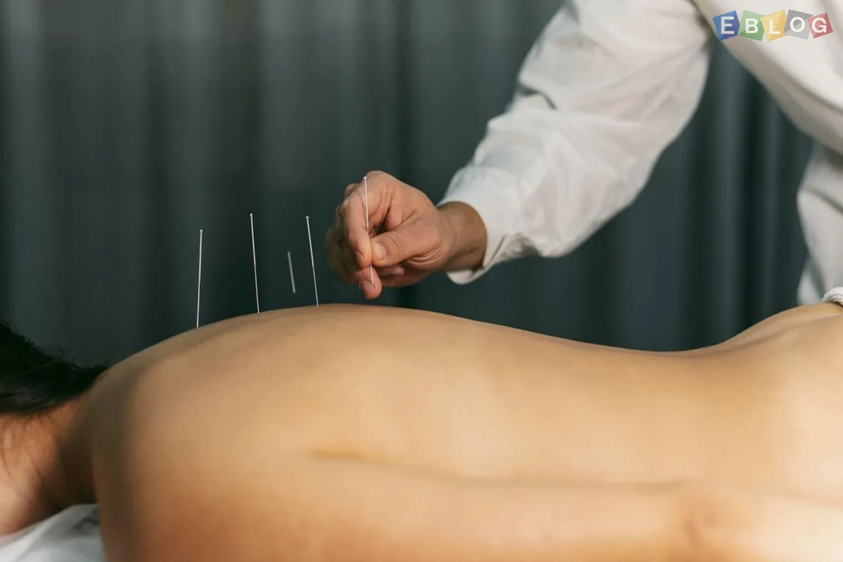 How Acupuncture Can Improve Your Health and Well-Being